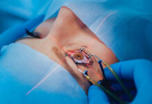 Chirurgie de la cataracte