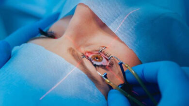 Chirurgie de la cataracte