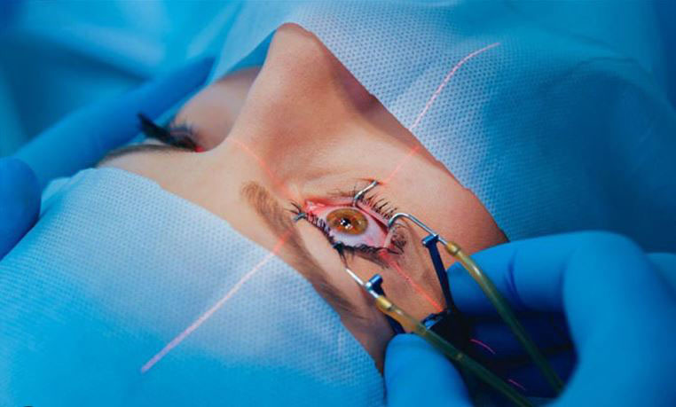 Chirurgie de la cataracte