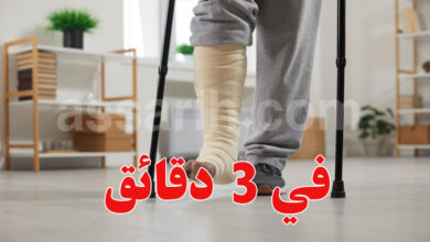 fracture jambe