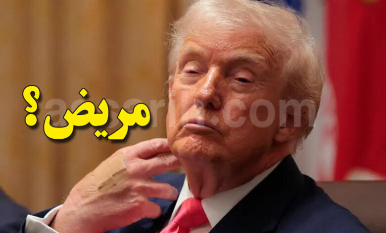TRUMP BRUISES