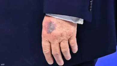 Trump bruise