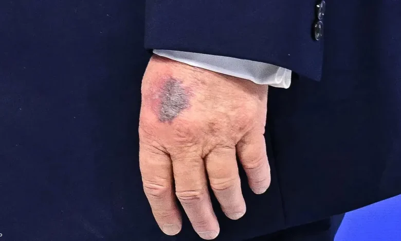 Trump bruise